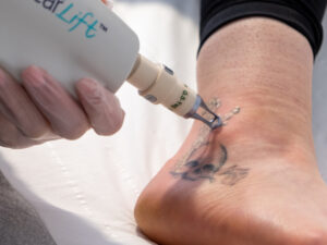 What Is Tattoo Removal?